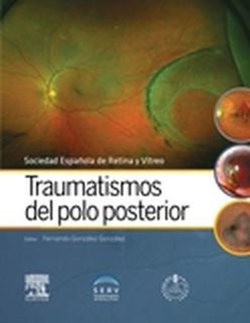 Traumatismos del polo posterior + acceso web | 9788491130529 | Serv, Sociedad Española de Retina y Vítreo